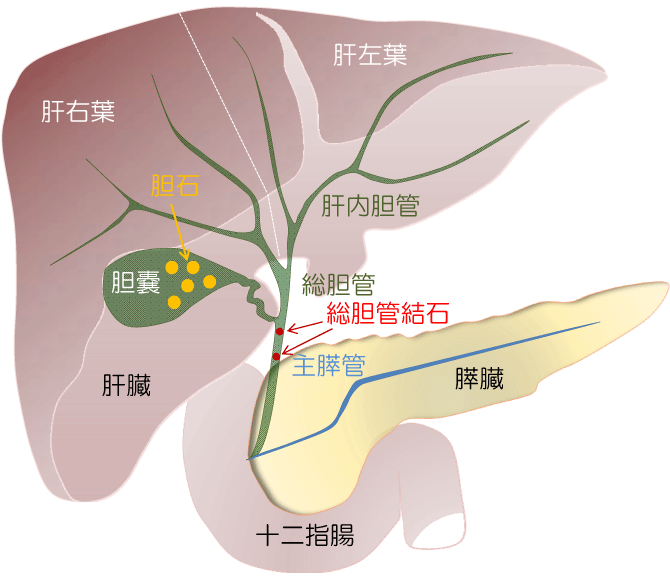 総胆管結石に対する内視鏡治療方法の概略・麻酔方法