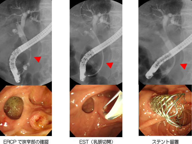 悪性下部胆管狭窄に対する金属ステント留置術の実際