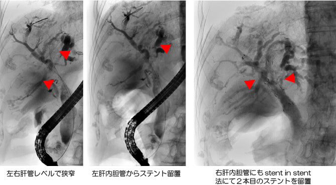 肝門部胆管がんに対するマルチステンティング