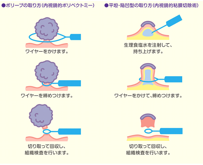 大腸ポリープ（大腸腺腫）・早期大腸がんに対する内視鏡的治療方法の概略・麻酔方法