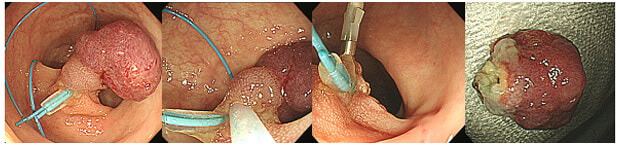 内視鏡的ポリペクトミーの実際