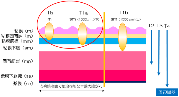 早期大腸がんに対する内視鏡的治療（ESD）