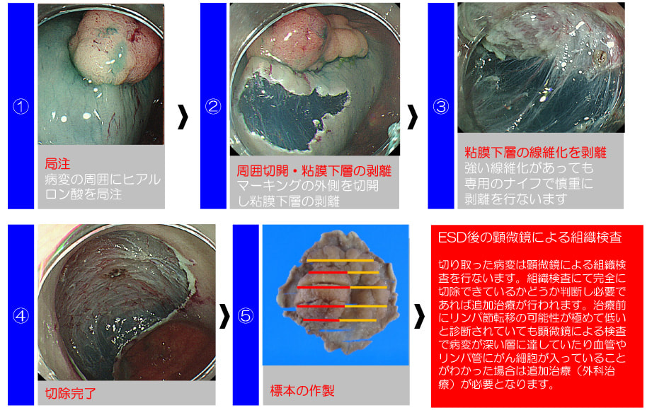 早期大腸がんに対する内視鏡的治療方法の概略・麻酔方法