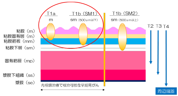 胃腺腫・早期胃がんに対する内視鏡的治療（ESD）