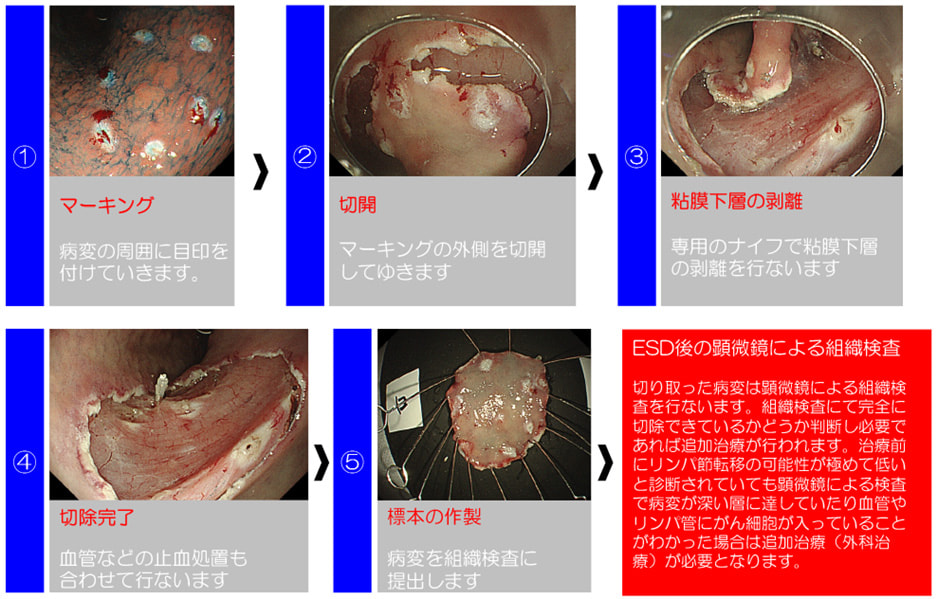 胃腺腫・早期胃がんに対する治療方法の概略・麻酔方法