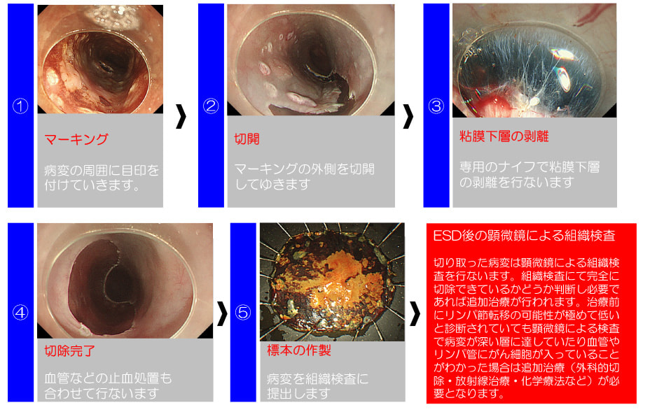 早期食道がんに対する内視鏡的治療（ESD）