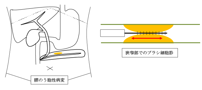 診断的ERCP治療方法の概略・麻酔方法1