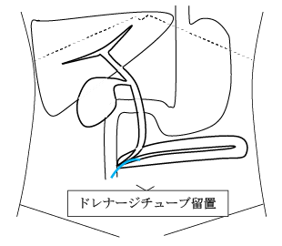 診断的ERCP治療方法の概略・麻酔方法2