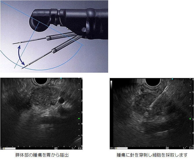 超音波内視鏡を用いた診断治療（超音波内視鏡下吸引細胞診；EUS-FNA）