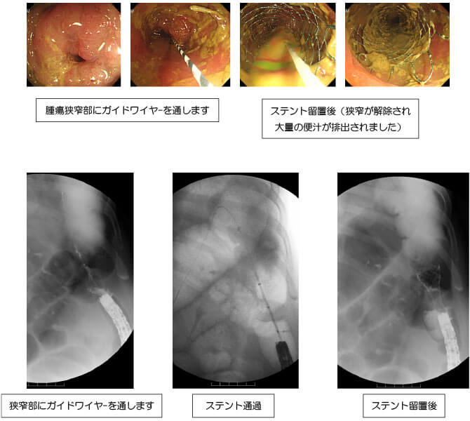 通過障害を伴う悪性大腸狭窄に対するステント治治療方法の概略・麻酔方法