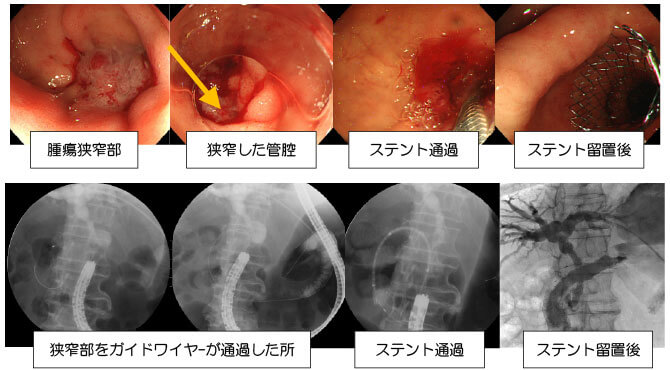 通過障害を伴う、悪性胃・十二指腸狭窄に対するステント治療方法の概略・麻酔方法