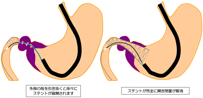 通過障害を伴う、悪性胃・十二指腸狭窄に対するステント治療方法の概略・麻酔方法