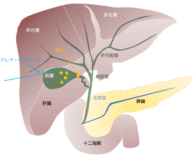 経皮経肝胆のうドレナージ術治療方法の概略・麻酔方法